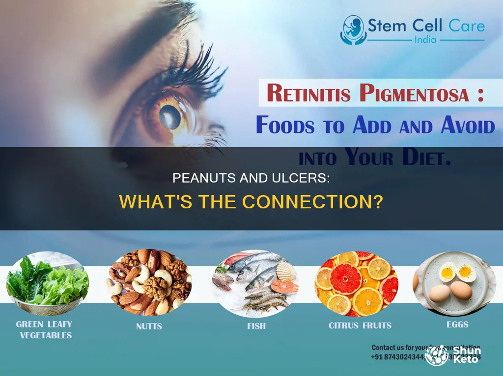 are peanuts ok on an ulcer diet