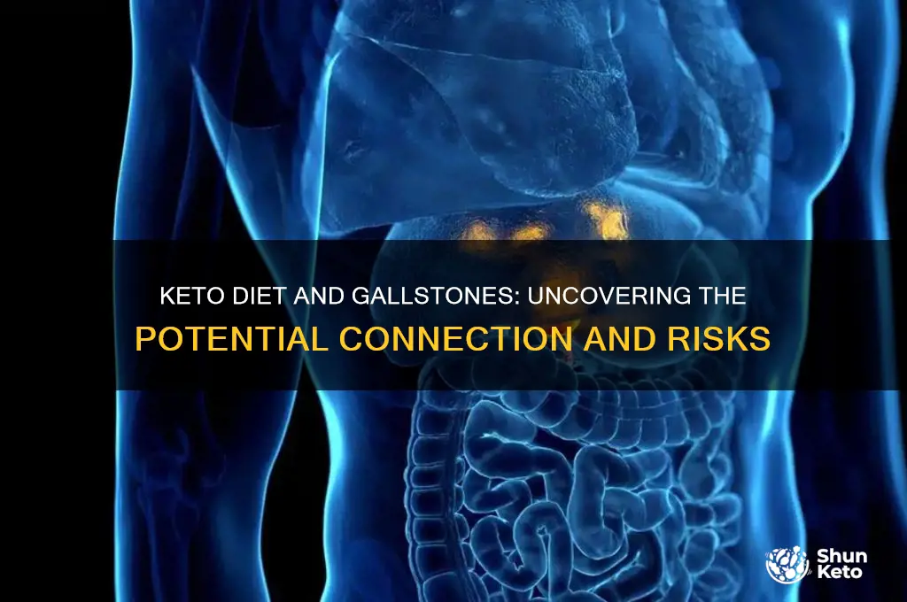 can a keto diet cause gallstones