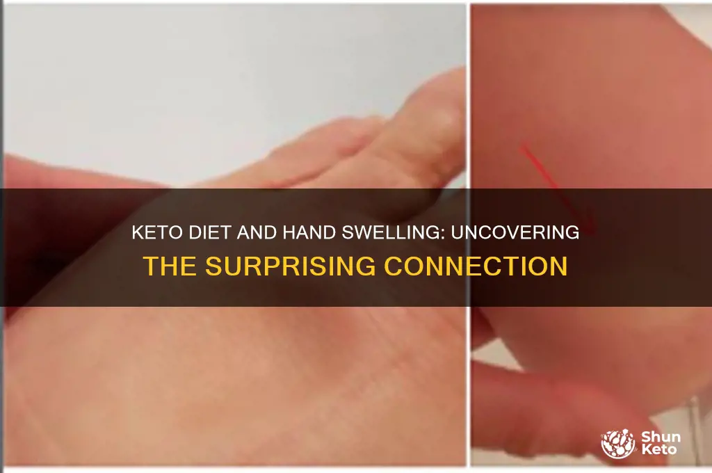 can a keto diet cause hands to swell
