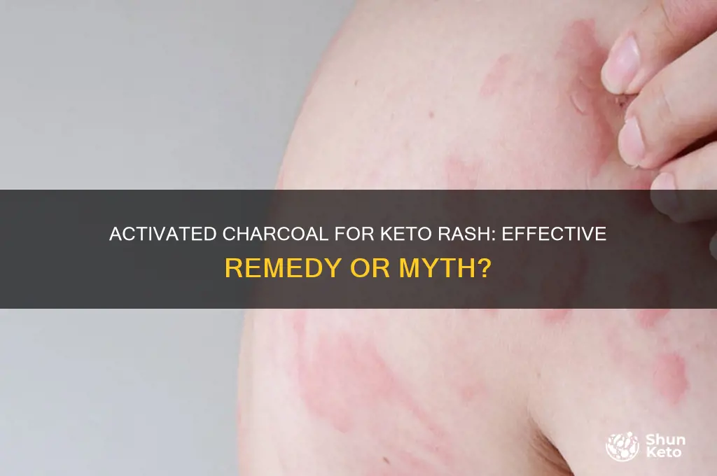 can activated charcoal help with keto rash