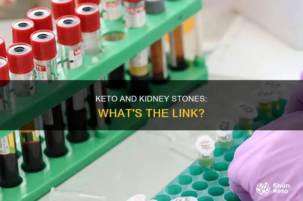 can eating keto cause kidney stones