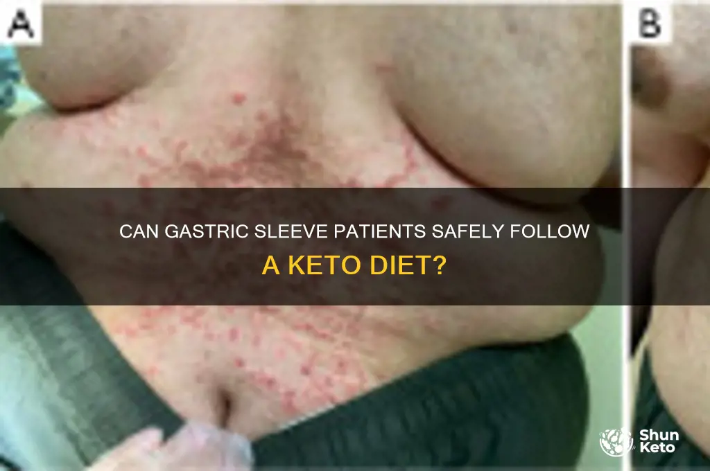 can gastric sleeve patients do keto