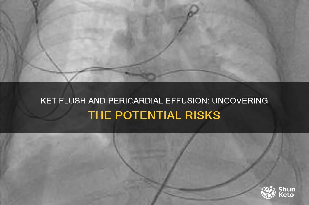 can ket flush cause pericardial effusion