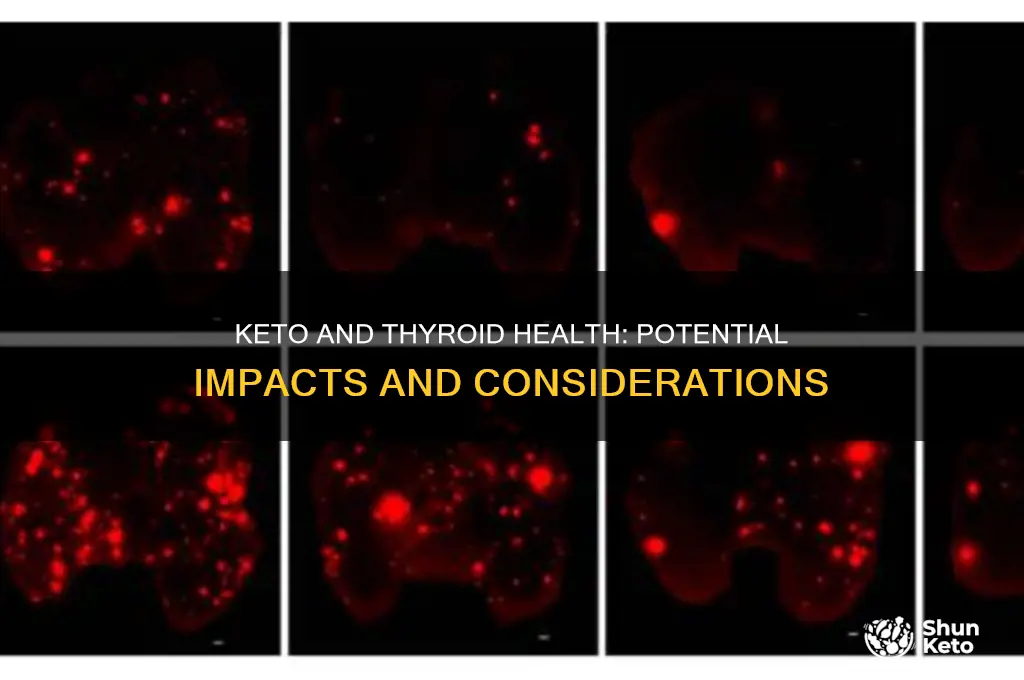 can keto affect a thyroid condition