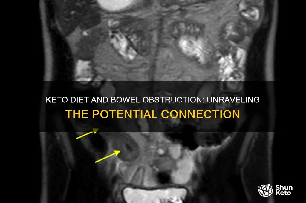 can keto cause bowel obstruction