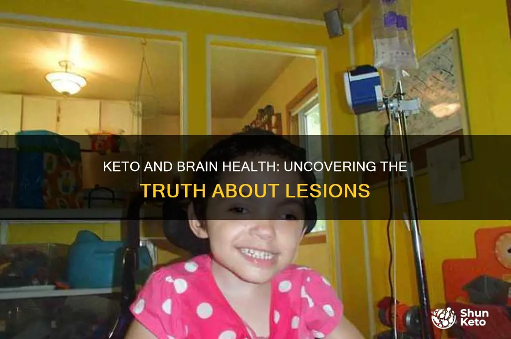 can keto cause brain lesions