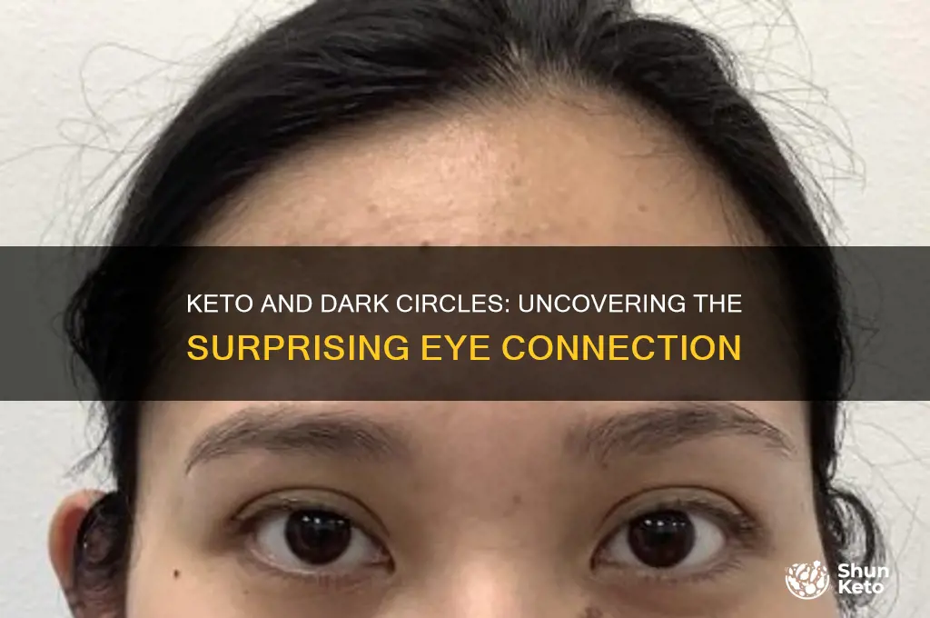 can keto cause dark circles under eyes
