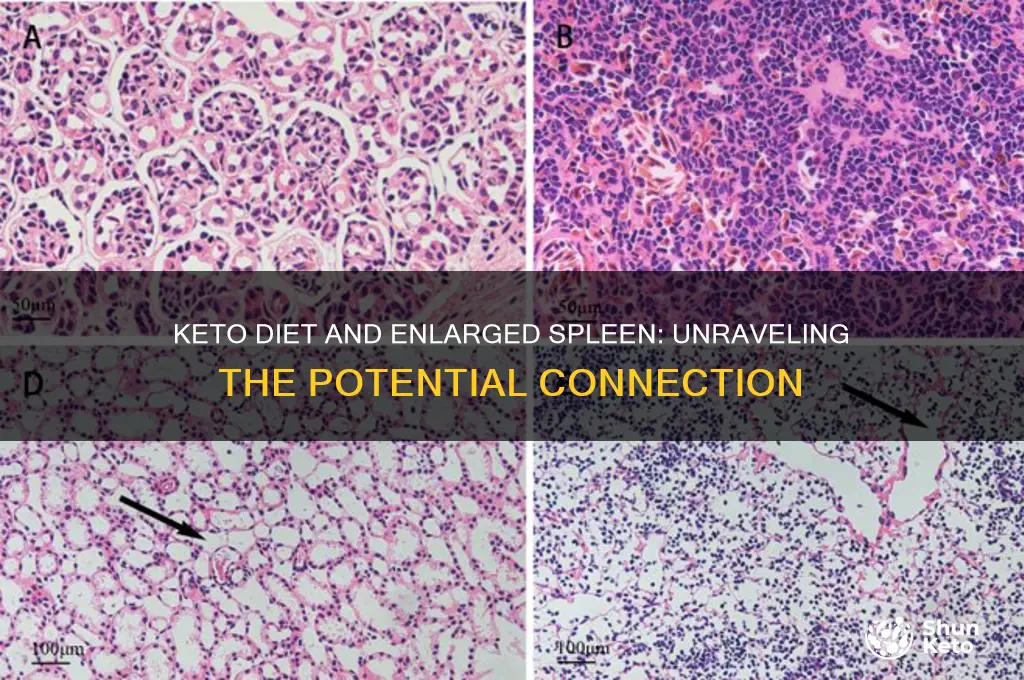 can keto cause enlarged spleen
