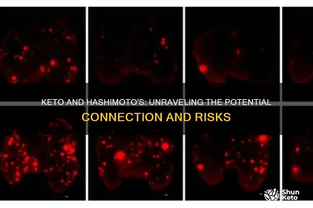 can keto cause hashimoto