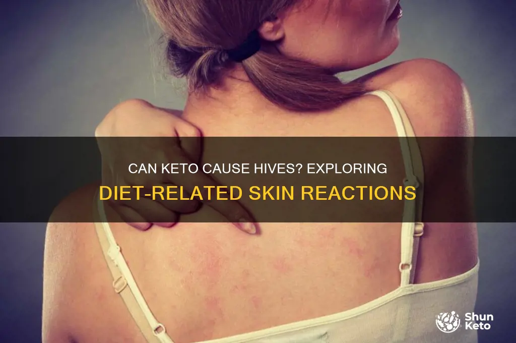 can keto cause hives