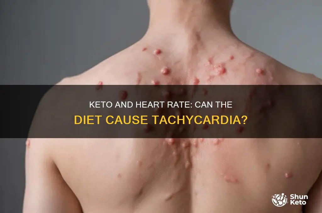 can keto cause tachycardia