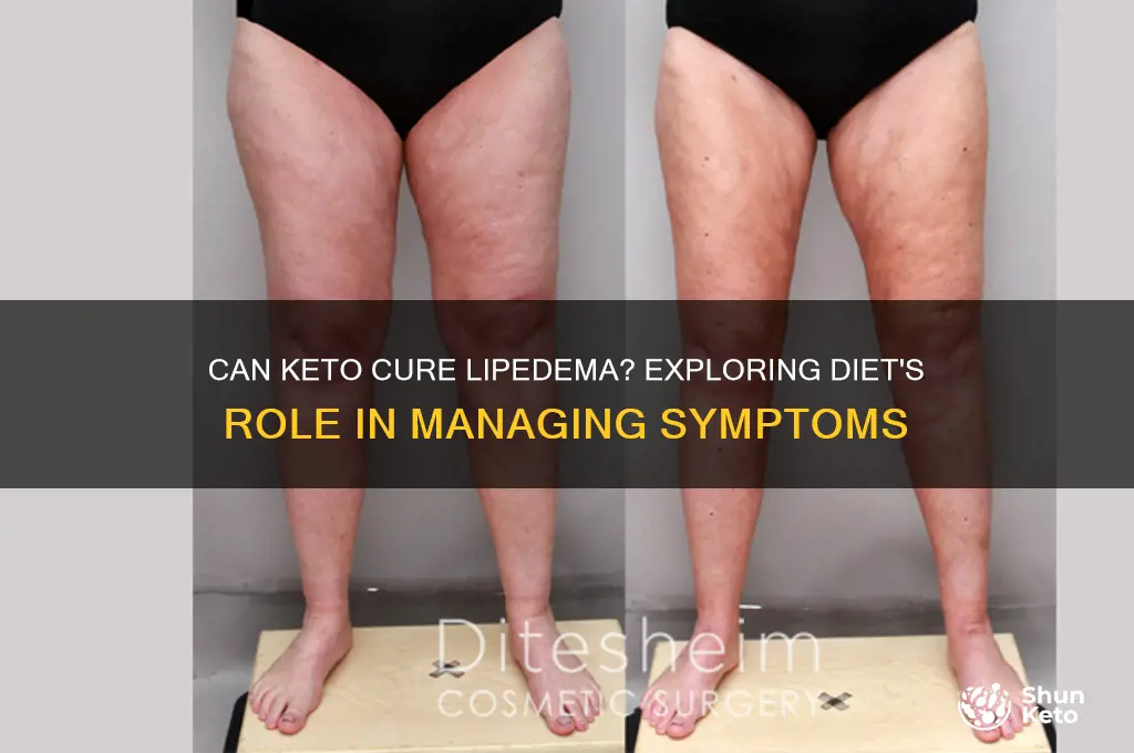can keto cure lipedema