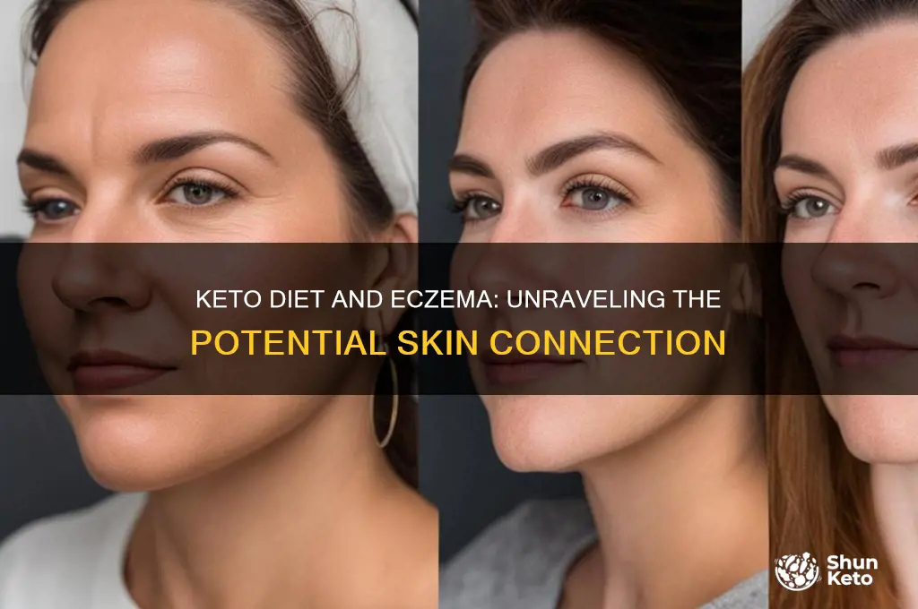 can keto diet cause eczema