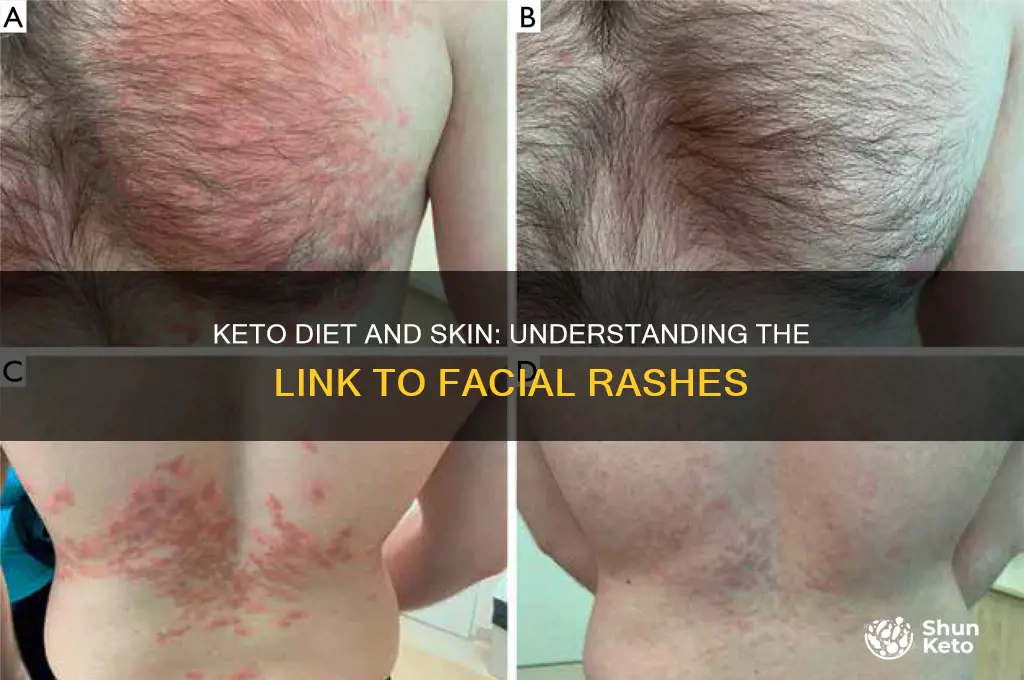 can keto diet cause face rash