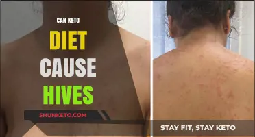 Keto Diet and Hives: Unraveling the Skin Reaction Mystery