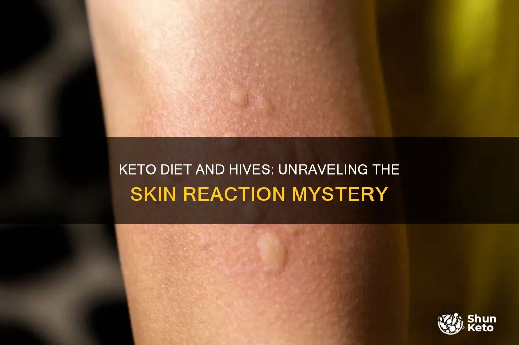 can keto diet cause hives