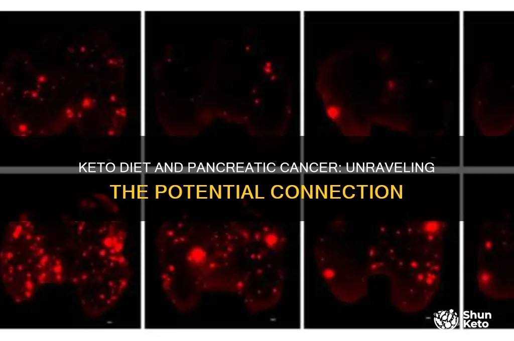 can keto diet cause pancreatic cancer
