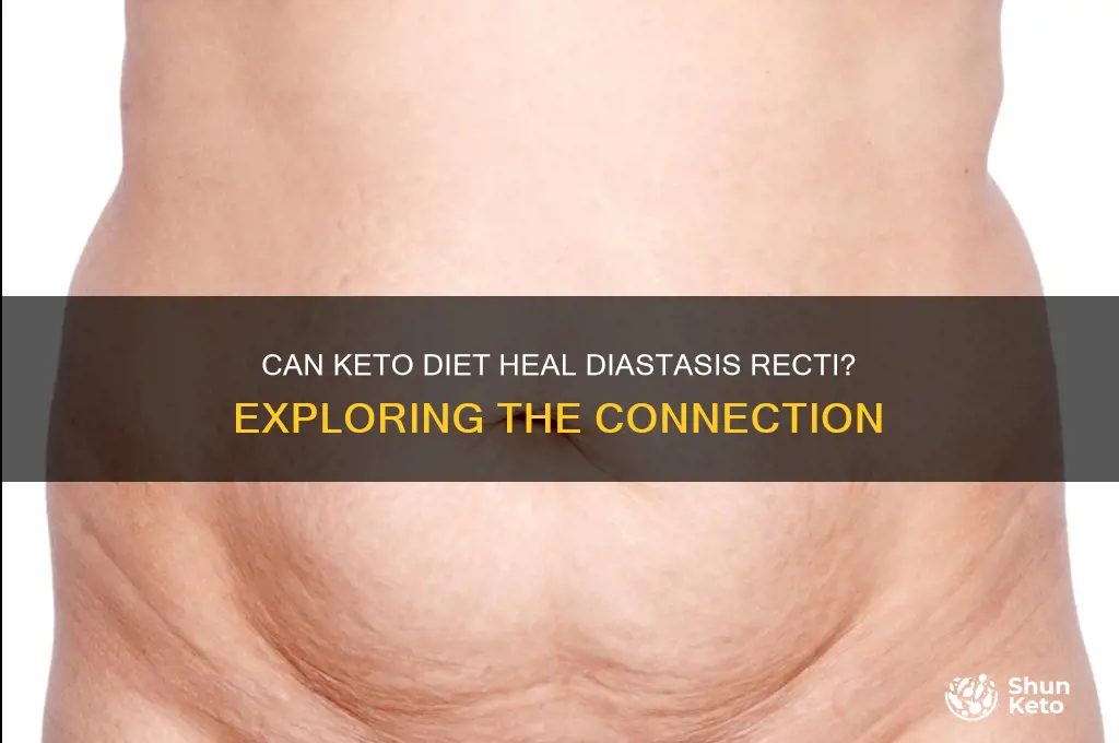 can keto diet fix diastasis recti