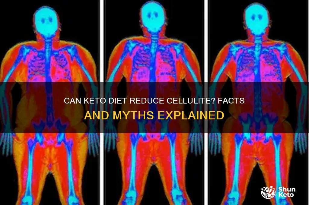can keto diet get rid of cellulite