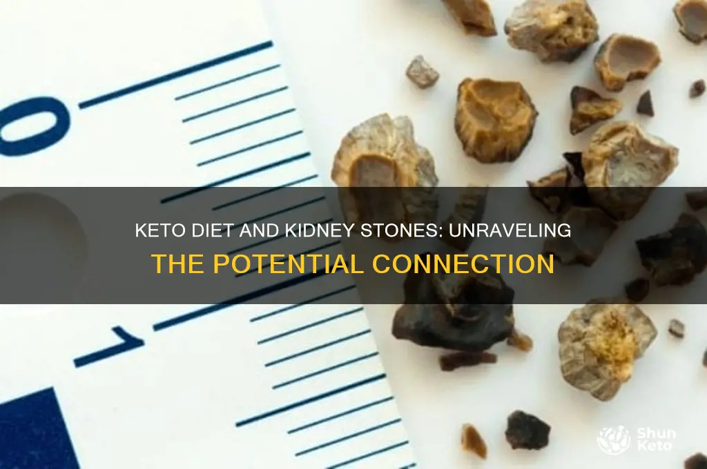 can keto diet give you kidney stones