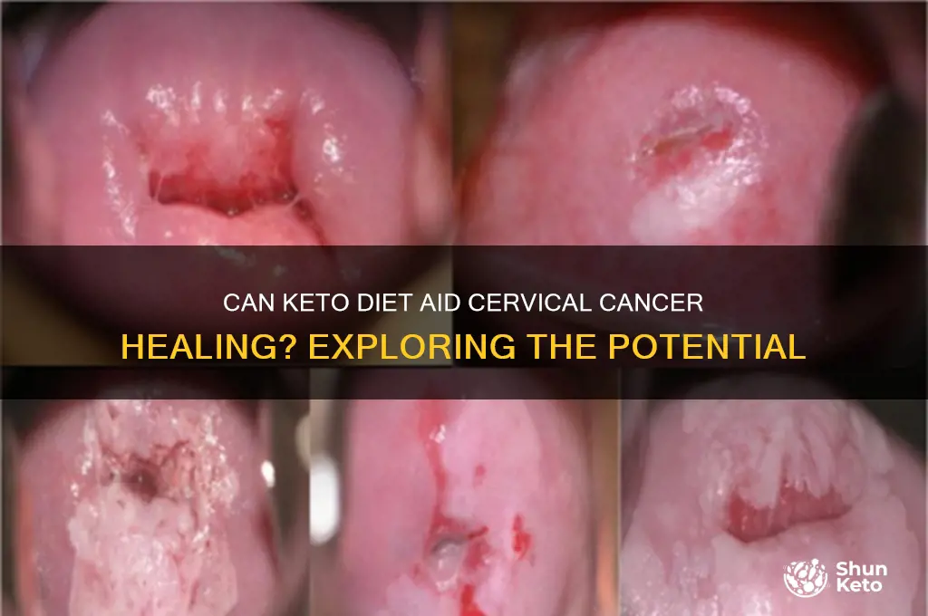 can keto diet heal cervical cancer