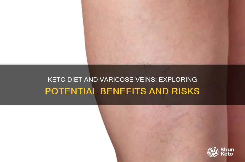can keto diet help varicose veins