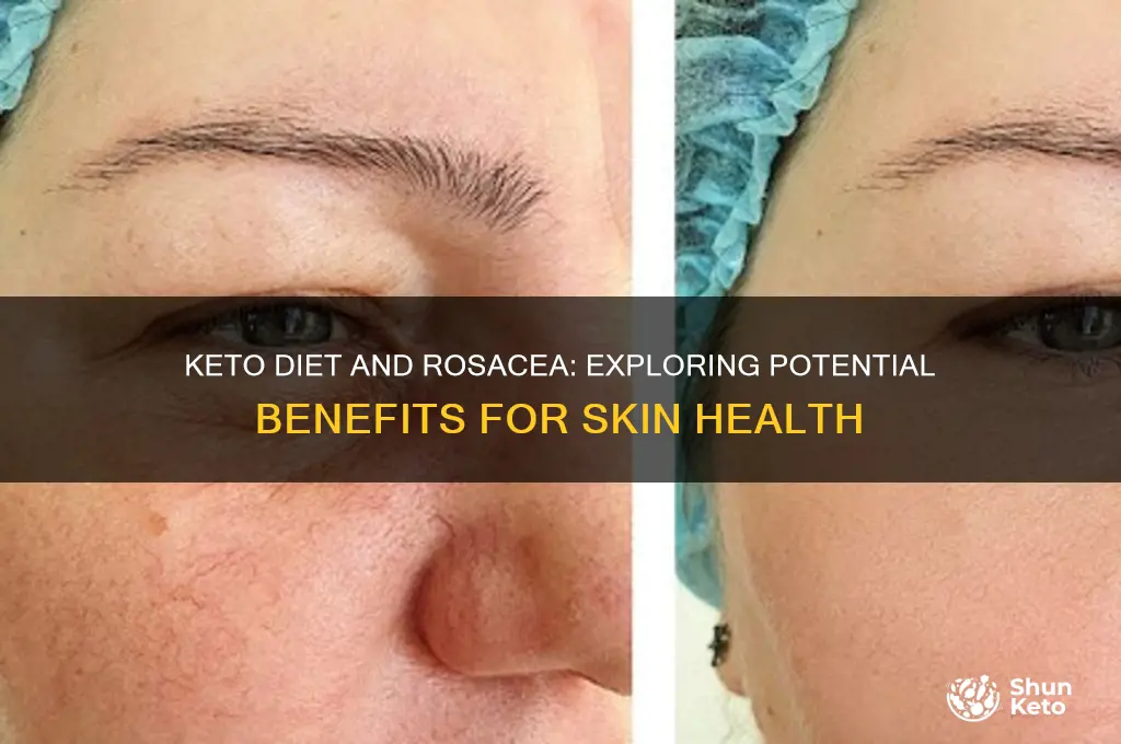 can keto help rosacea