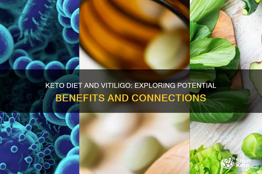 can keto help vitiligo