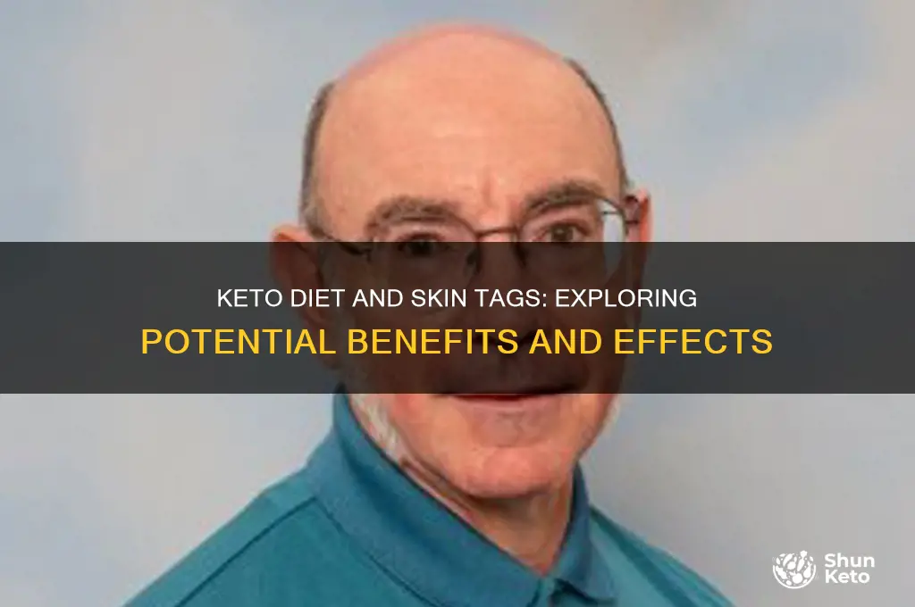 can keto help with skin tags