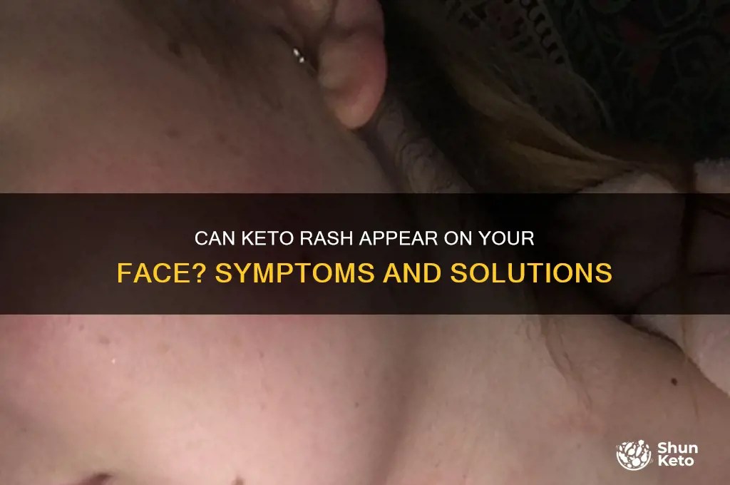 can keto rash happen on your face