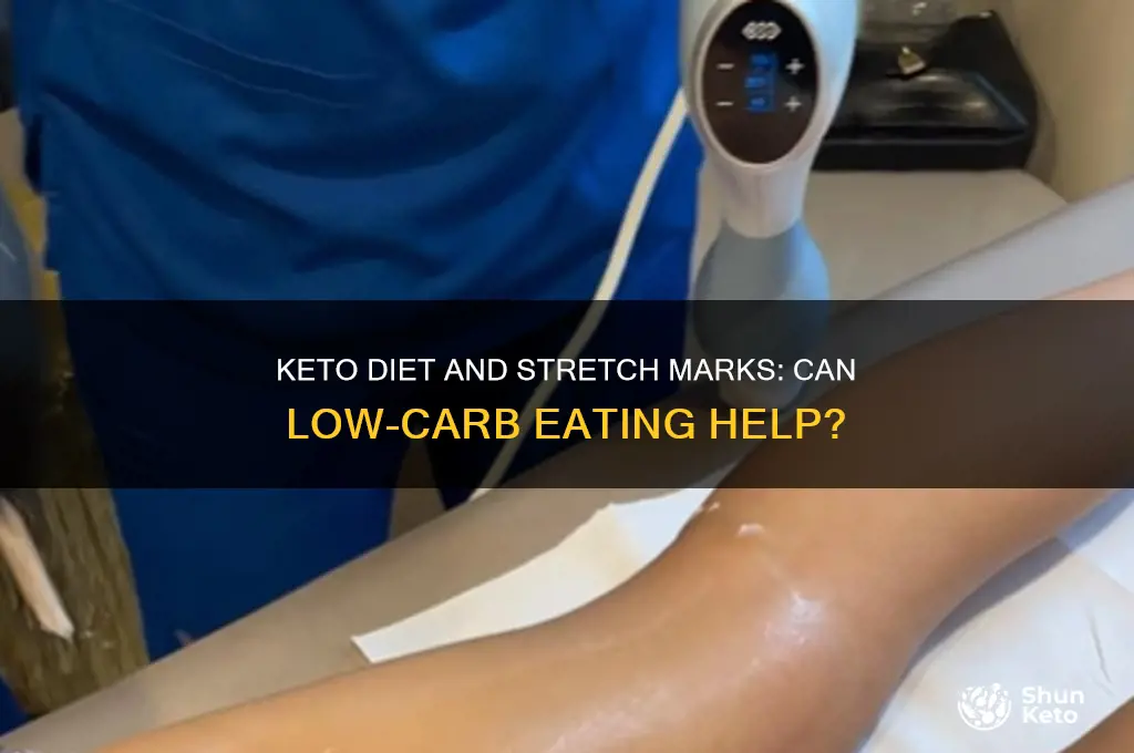 can keto reduce stretch marks