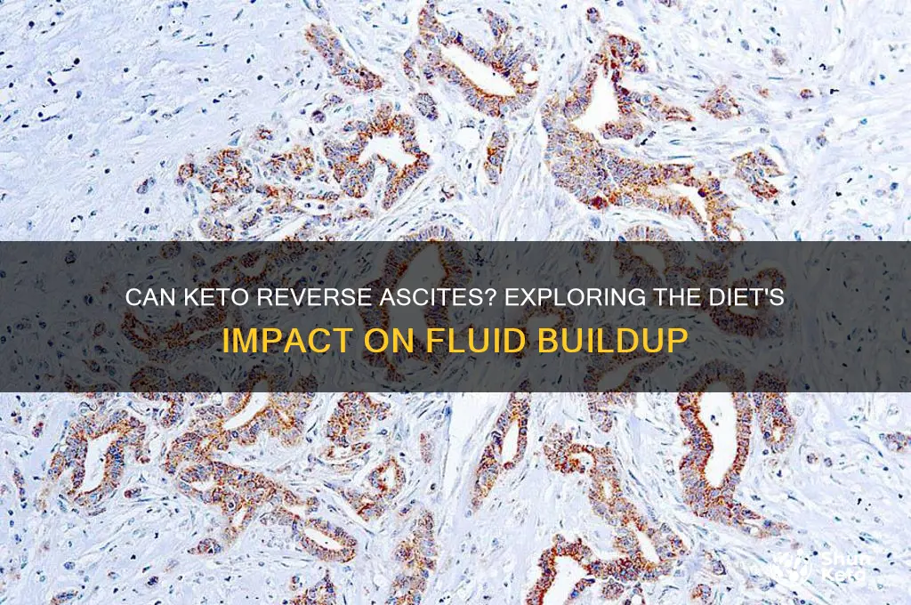 can keto reverse ascites