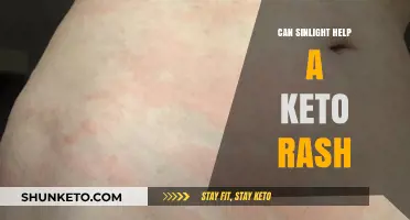 Can Sunlight Relieve Keto Rash Symptoms? Exploring Natural Remedies