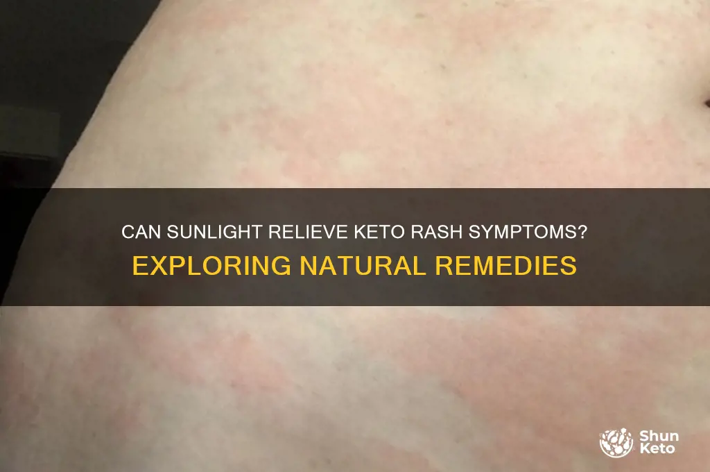 can sinlight help a keto rash