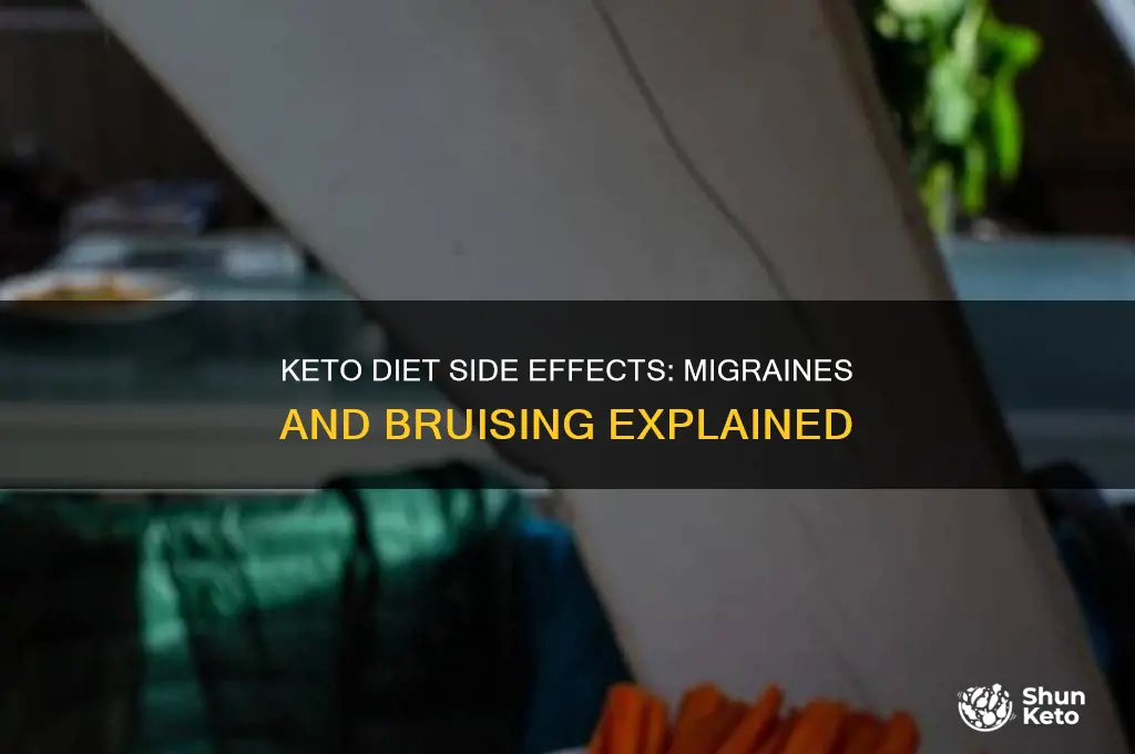 can the keto diet cause migraines and bruising