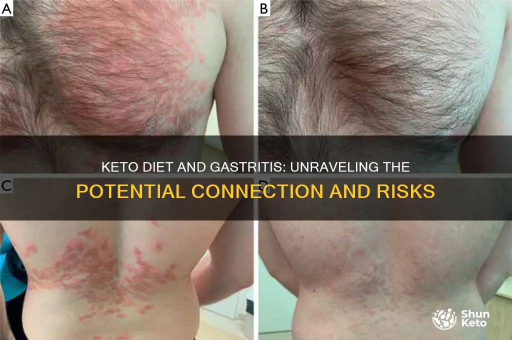 can you develop gastritis from a keto diet