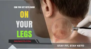 Keto Rash on Legs: Causes, Symptoms, and Effective Treatment Options