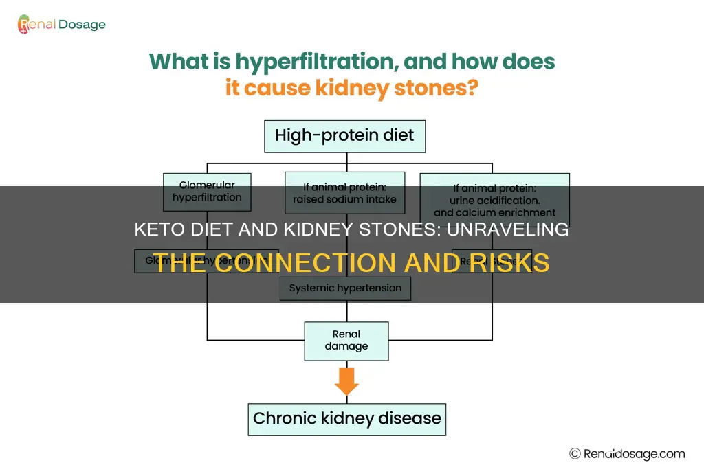 can you get kidney stones from keto diet