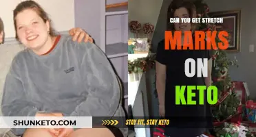 Keto and Stretch Marks: Unraveling the Skin Changes Mystery