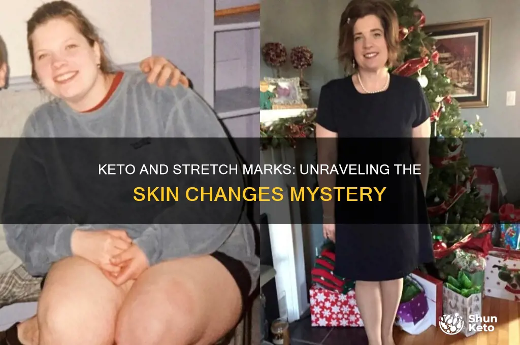 can you get stretch marks on keto