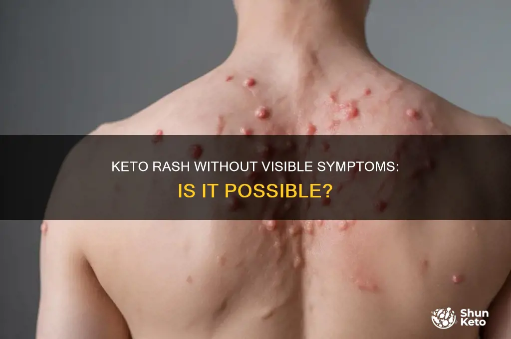 can you have keto rash without the rash