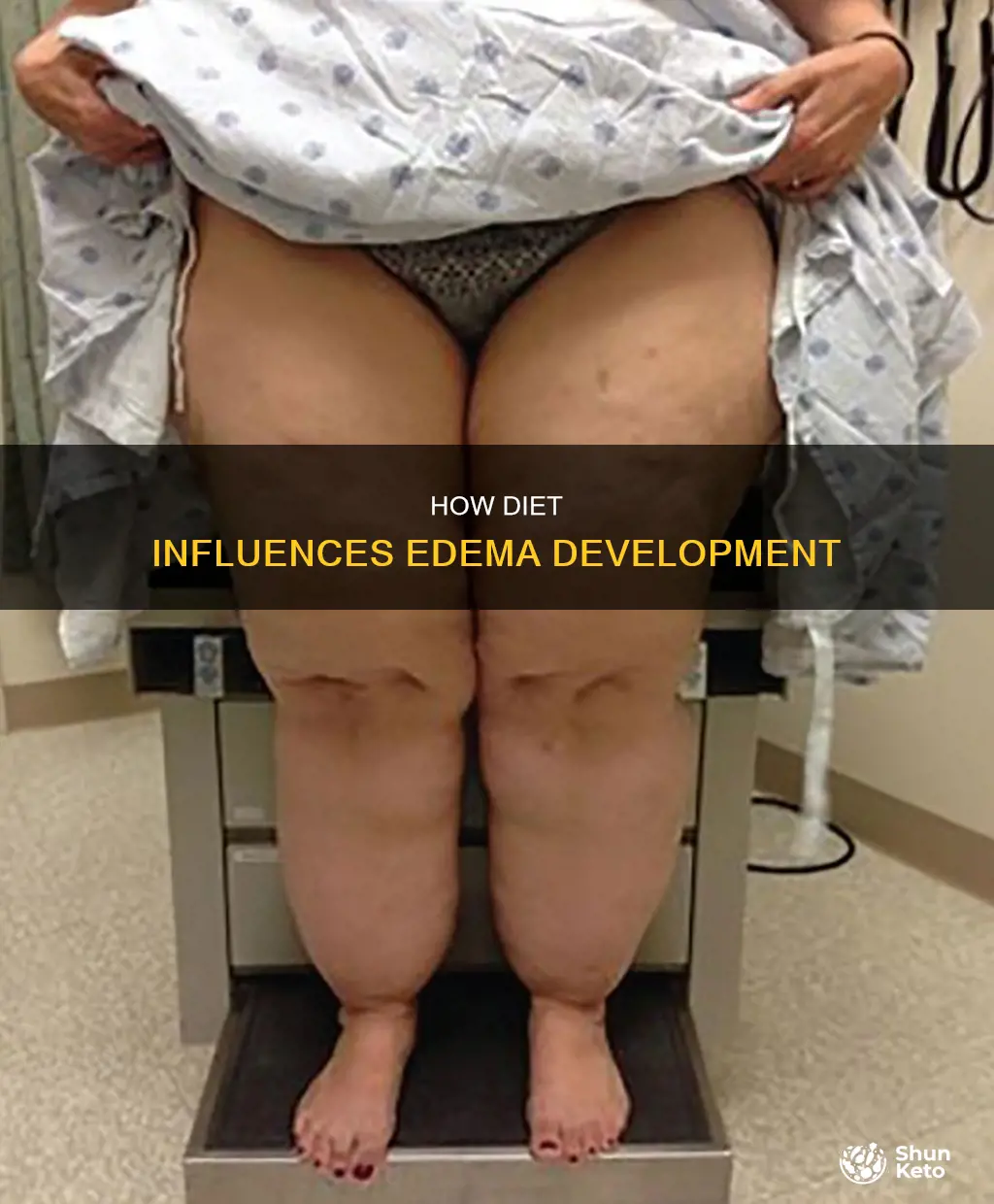 could poor diet cause edema