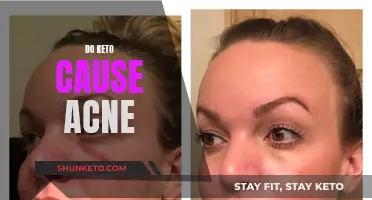 Keto and Acne: Is There a Link?