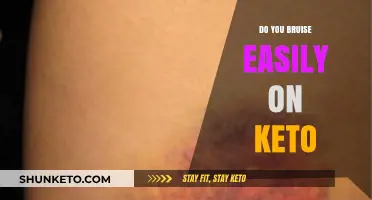 Keto and Bruising: Understanding Why You Bruise Easily on a Low-Carb Diet