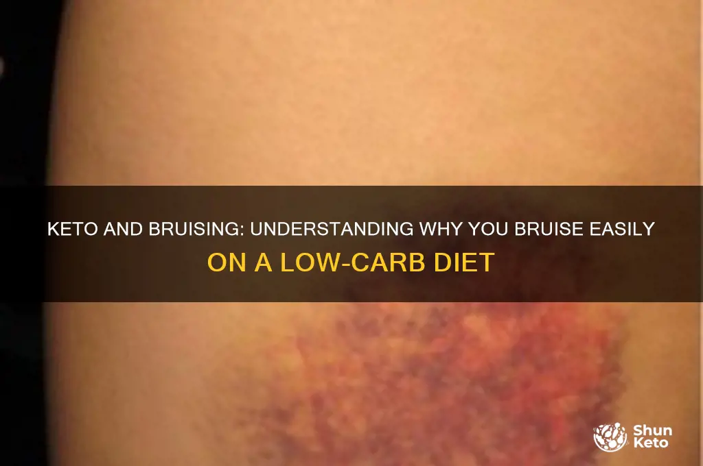 do you bruise easily on keto