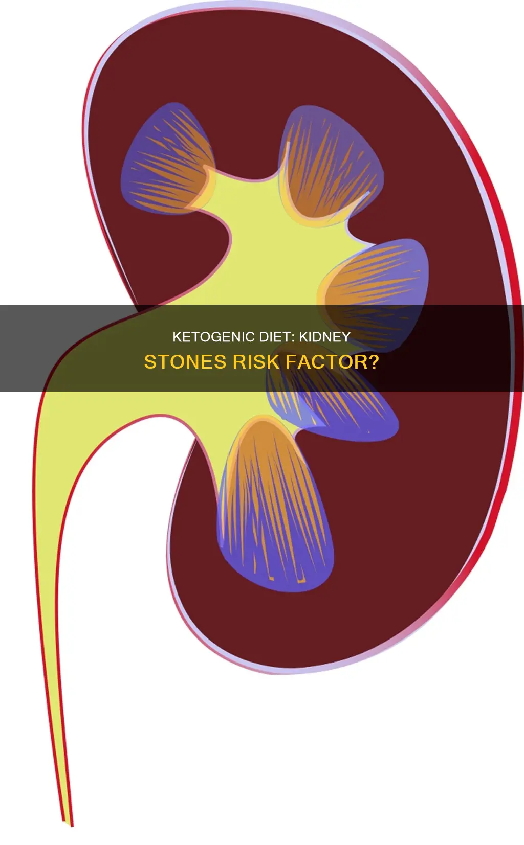 does a ketogenic diet cause kidney stones