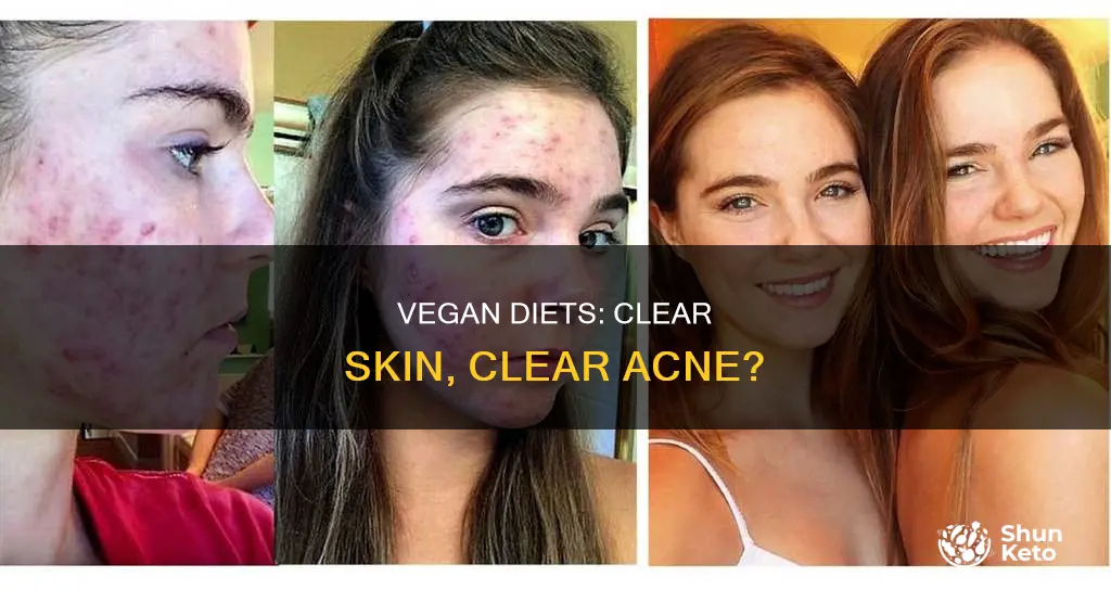 does a vegan diet help acne