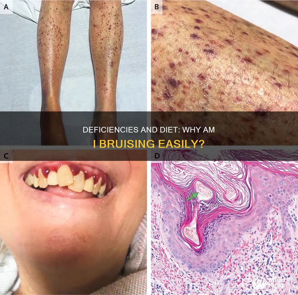 does any deficiency in diet causing bruising