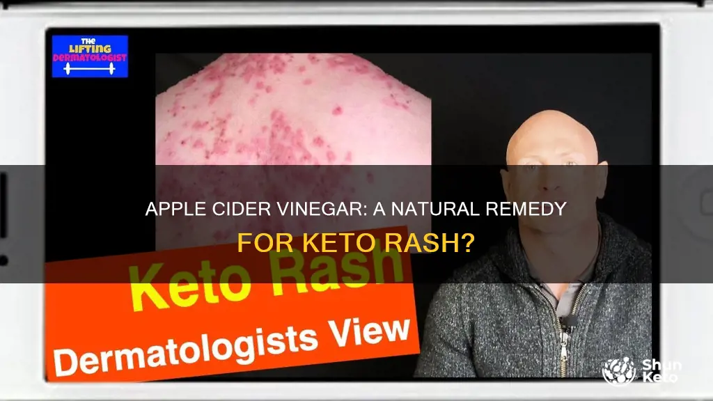 does apple cider vinegar help with keto rash