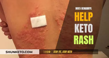 Benadryl's Effectiveness in Treating Keto Rash